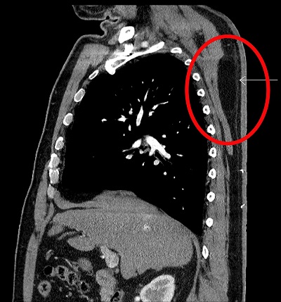 등에 ‘지방종’이 발생한 환자의 CT 검사 사진. (사진=순천향대 부천병원)
