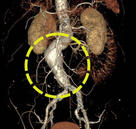 ‘복부대동맥류’는 뱃속 가장 굵은 혈관인 ‘복부대동맥’이 여러 가지 이유로 풍선처럼 부풀어 오르는 질환이다. 복부대동맥류 환자의 3D CT 사진. (사진=순천향대 부천병원)